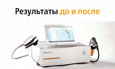 До и После AWT Storz Medical